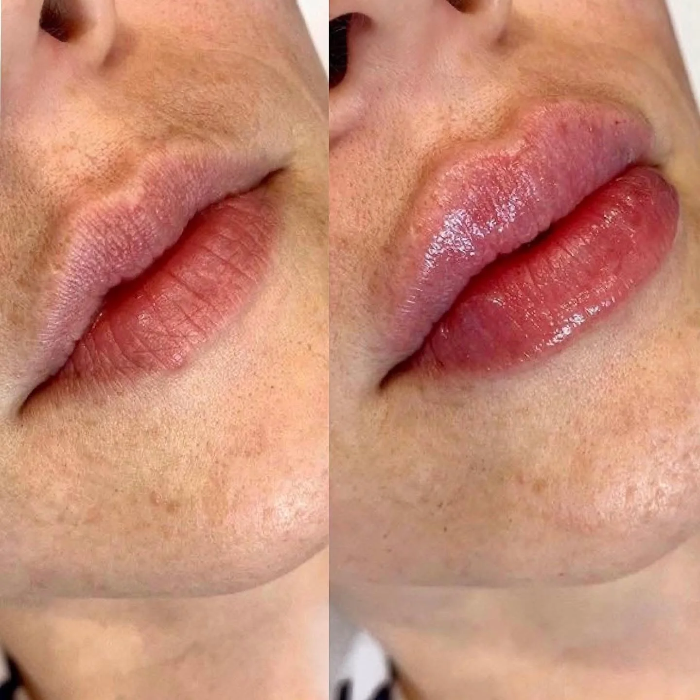 Prima e dopo dermopigmentazione labbra Vanity Lips