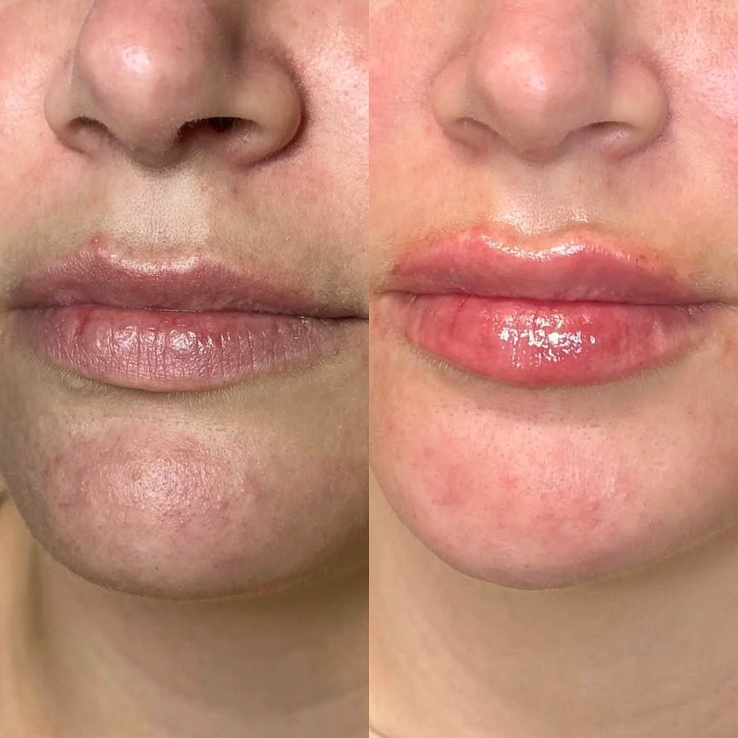 Prima e dopo filler labbra senza aghi Vanity Lips